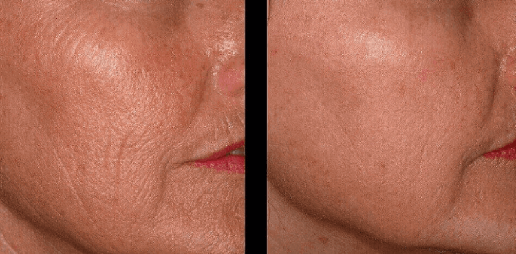 Обновление кожи лица