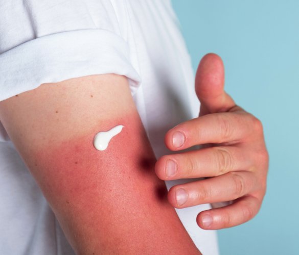 Почему SPF нужен уже в начале весны?